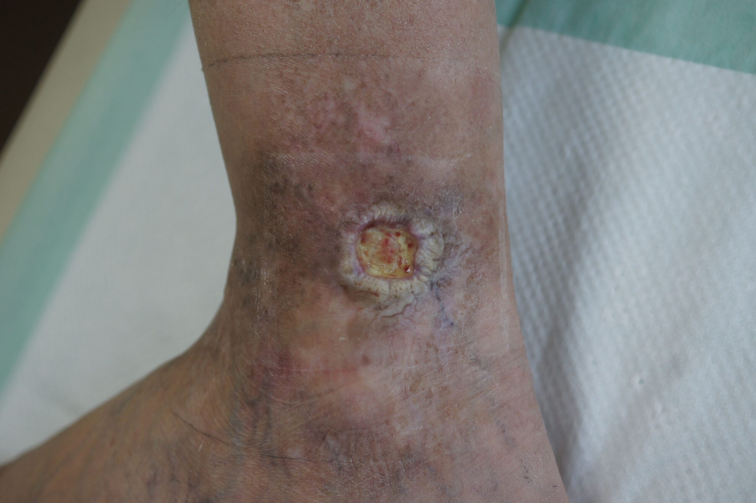 Venous Stasis Ulcers: Visual Guide and Symptoms Image