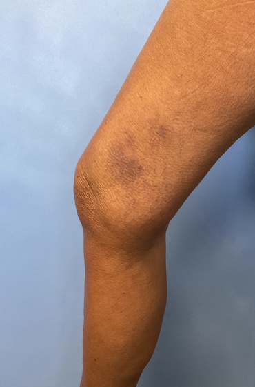 Spider Vein 110 After image