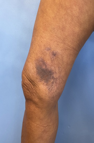 Spider Vein 110 Before image