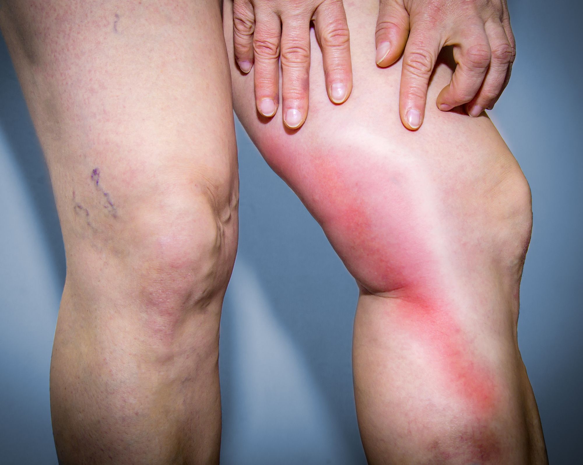 Superficial Venous Thrombosis: Why It’s Not as Harmless as It Sounds Image