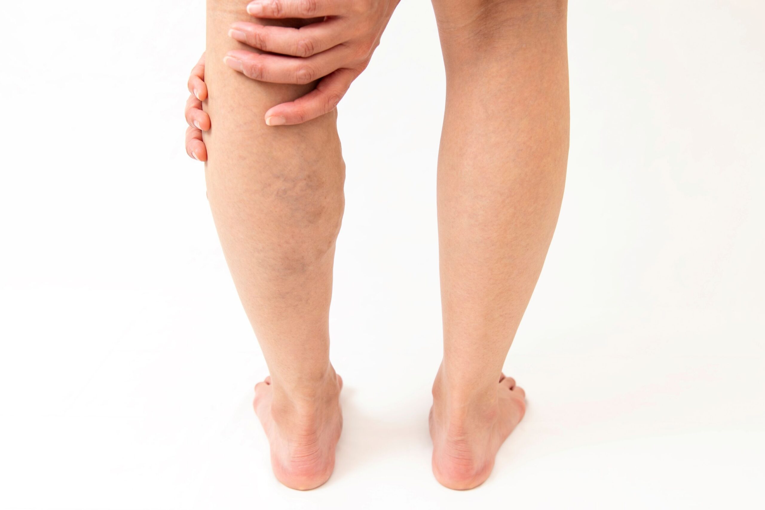 VenaSeal vs. RFA Below the Knee: Which Is Gentler on Your Nerves?  Image